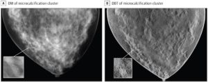 Synthetische Bilder, die beim Leistungsnachweis und damit der Zulassung eines Geräts für die „Digital Breast Tomosynthesis (DBT)“ verwendet wurde